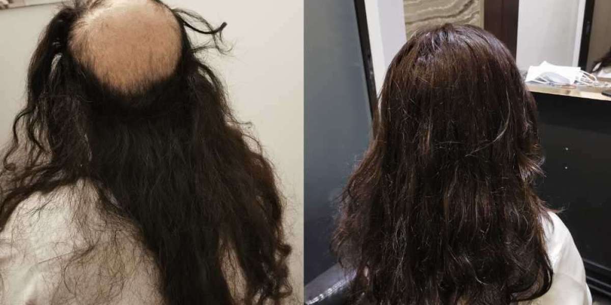 Hair Replacement Singapore