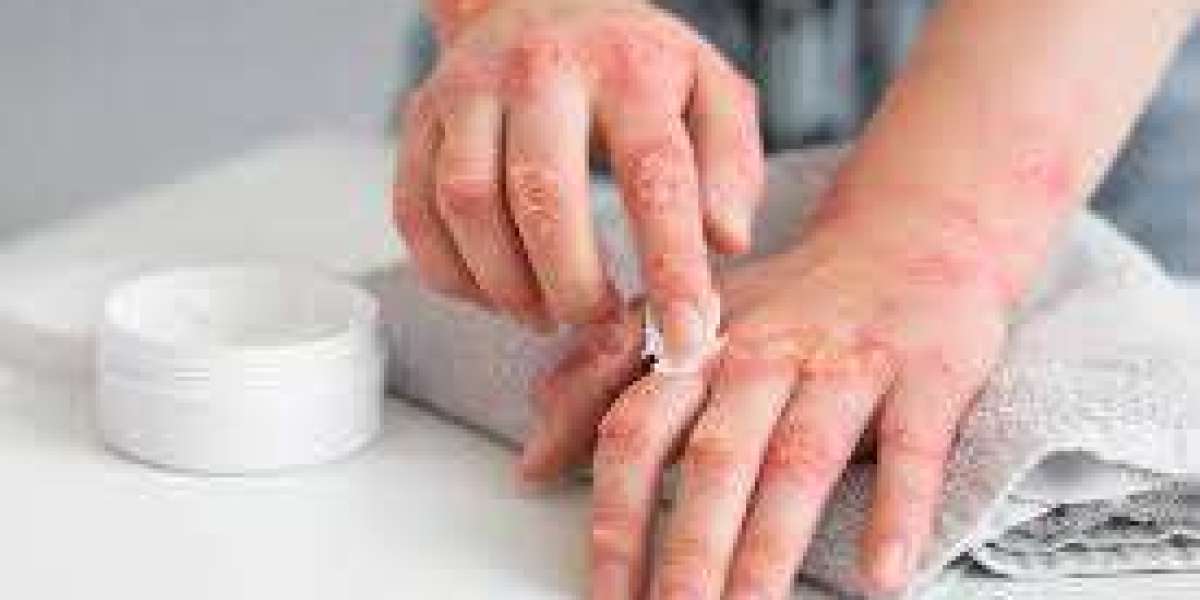 Ayurveda for Skin Health: Treat Skin Diseases Naturally