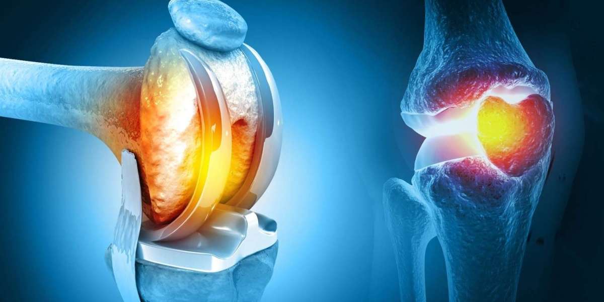 Total Knee Replacement in Islamabad: Step into a Pain-Free Life