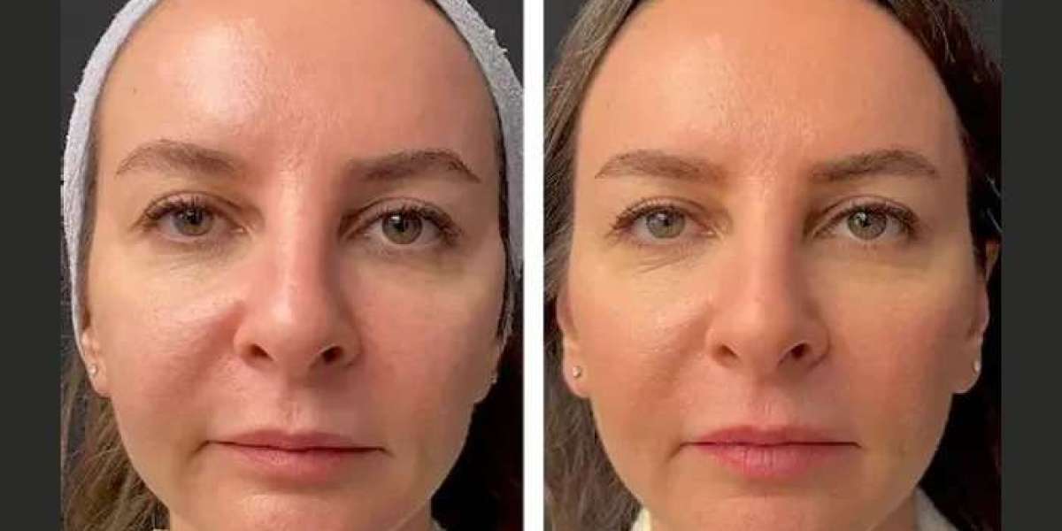 Mesotherapy vs. Fillers at Best Aesthetic Clinic in Dubai