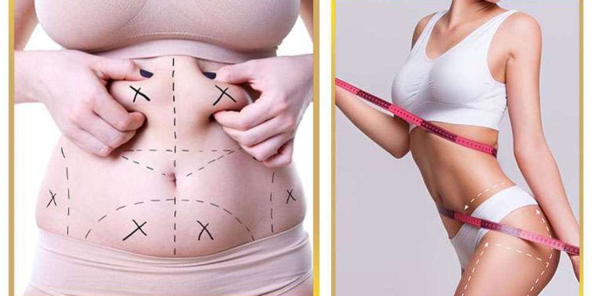 Top Benefits of Getting Liposuction in Islamabad
