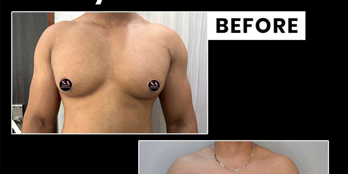 Best Gynecomastia Surgery in Delhi | Safe & Effective